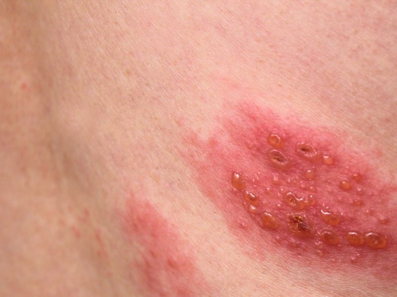 湿疹有什么症状